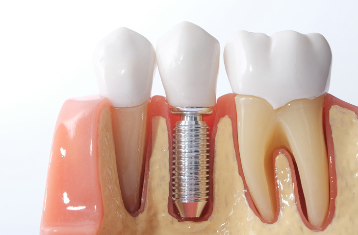 Bạn nên trồng răng Implant nếu phù hợp với tình trạng răng cũng như có mức tài chính ổn định