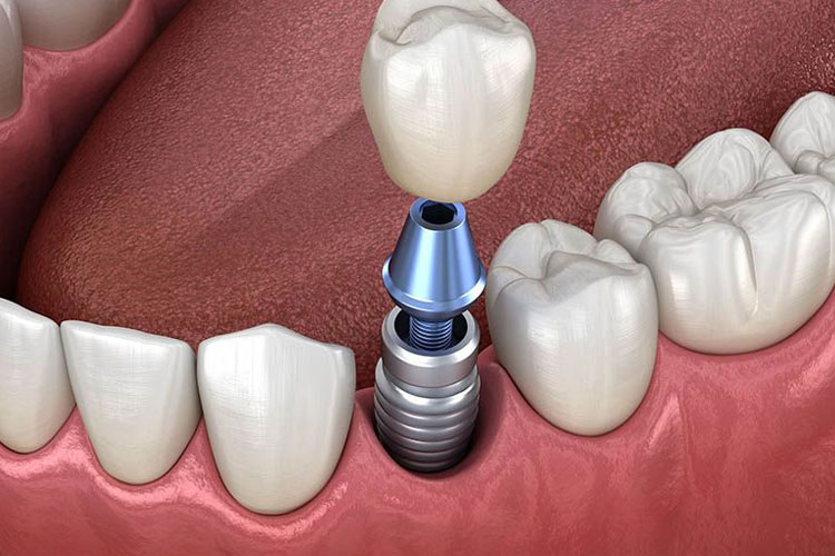 Có Nên Trồng Răng Implant Không? Chuyên Gia Giải Đáp