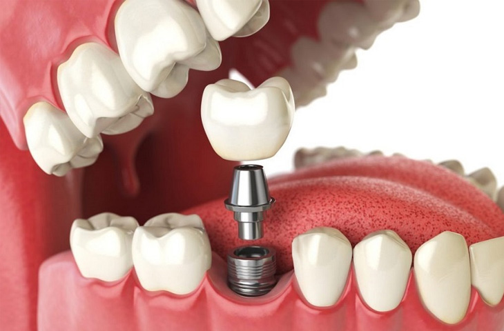 Trồng răng Implant khó có thể tránh khỏi đau nhức