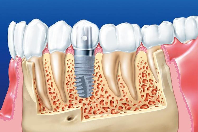 Trồng Răng Implant Có Đau Không? Cách Giảm Đau Hiệu Quả