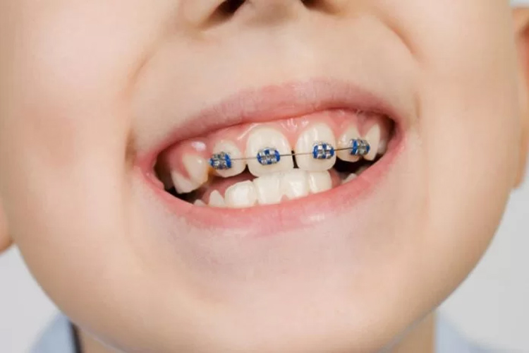 Niềng Răng Có Phải Nhổ Răng Không? Chuyên Gia Giải Đáp